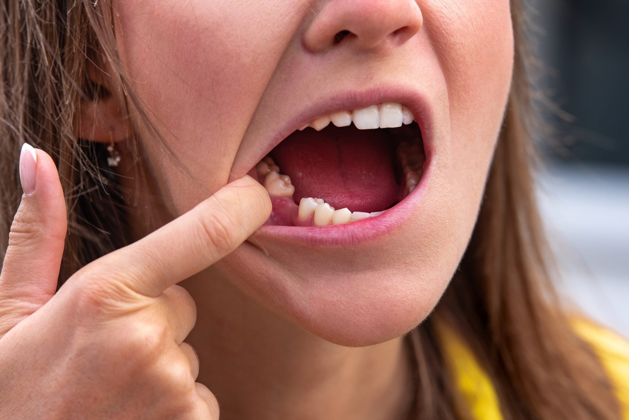 Sognare che cadano i denti cosa significa e perché accade Ohga!